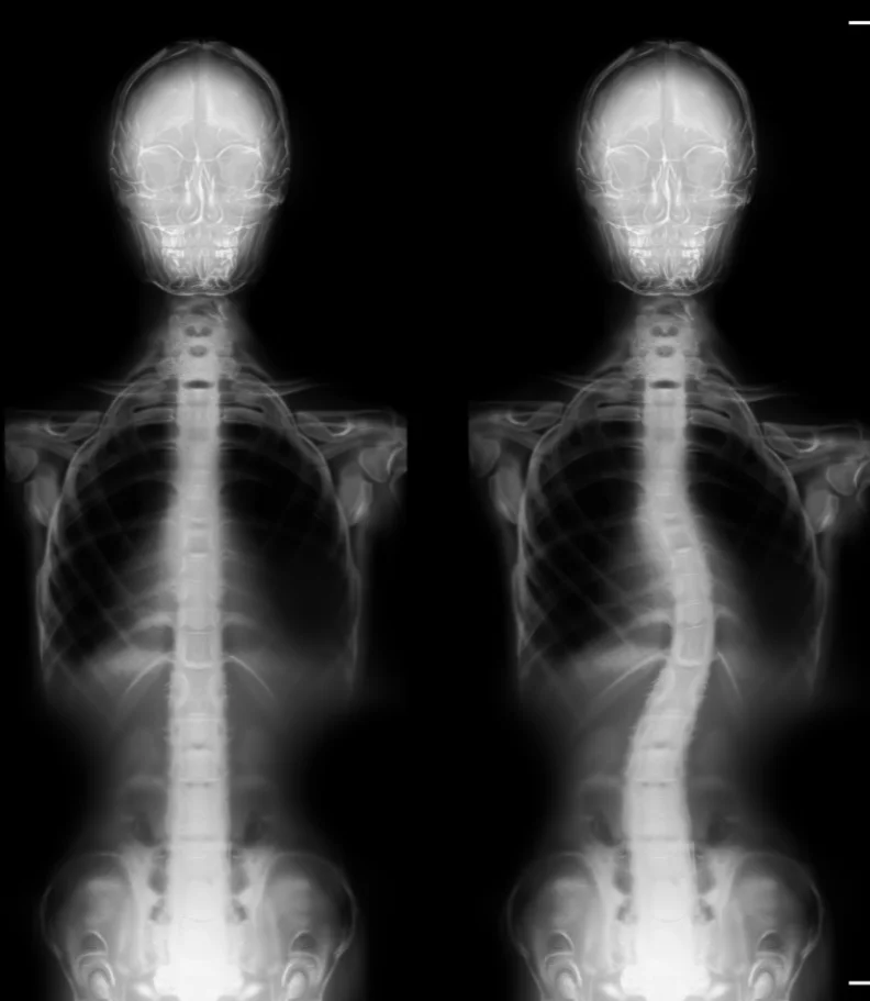 Scoliosis CITY*
